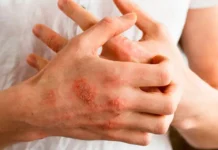 ¿Cómo evitar la dermatitis atópica?