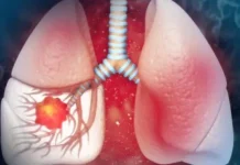 Humo que asesina: 80% cáncer pulmón se asocia al tabaco